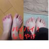 「しもやけ」をやっつけろっ！！13歳カワイイ盛り！花の中2女子の足の指10本全てが赤く、腫れて痒いーー。